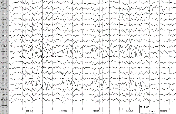 EEG recording