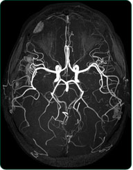 MRA brain axial